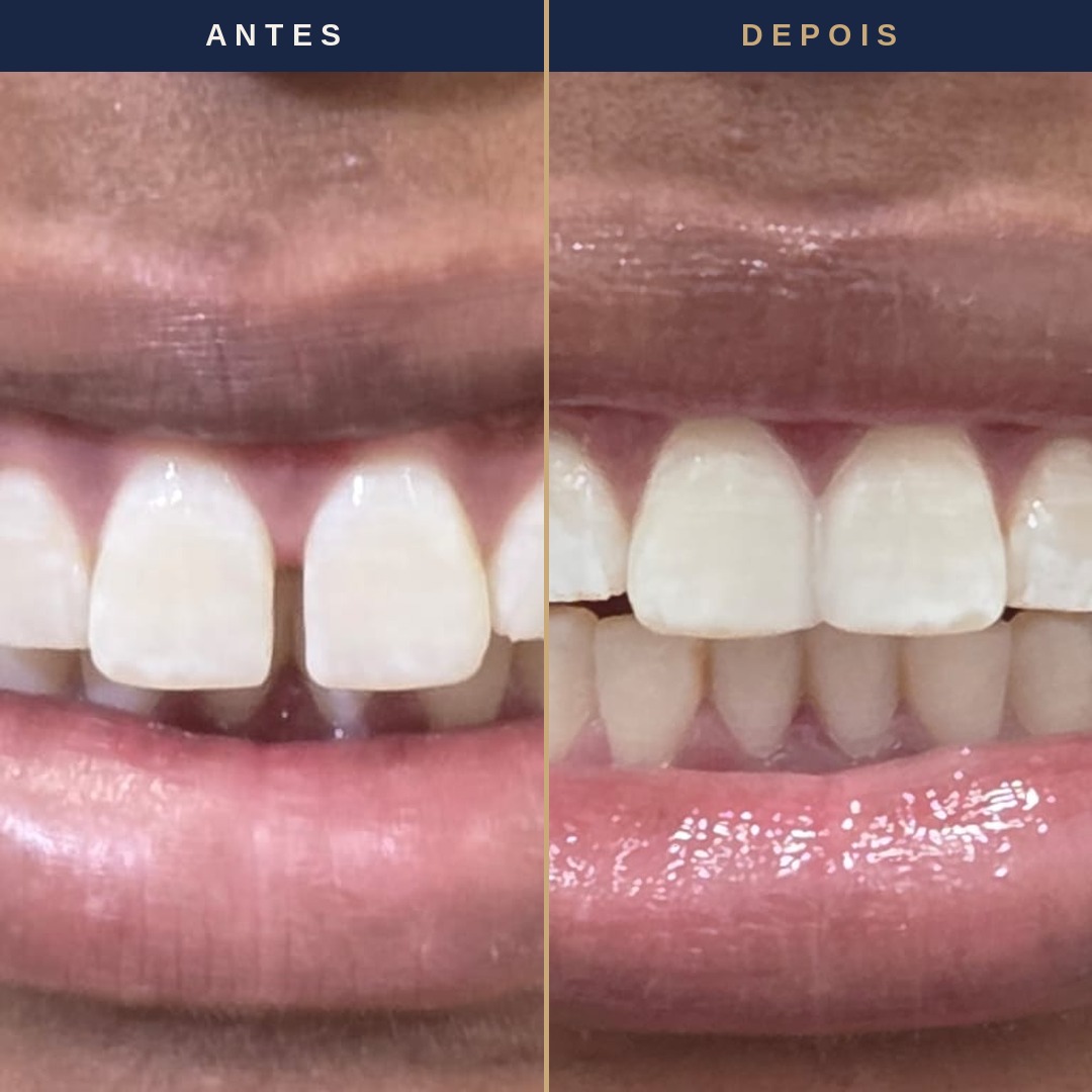 Antes e depois de lente de contato dental &mdash; paciente Felicity