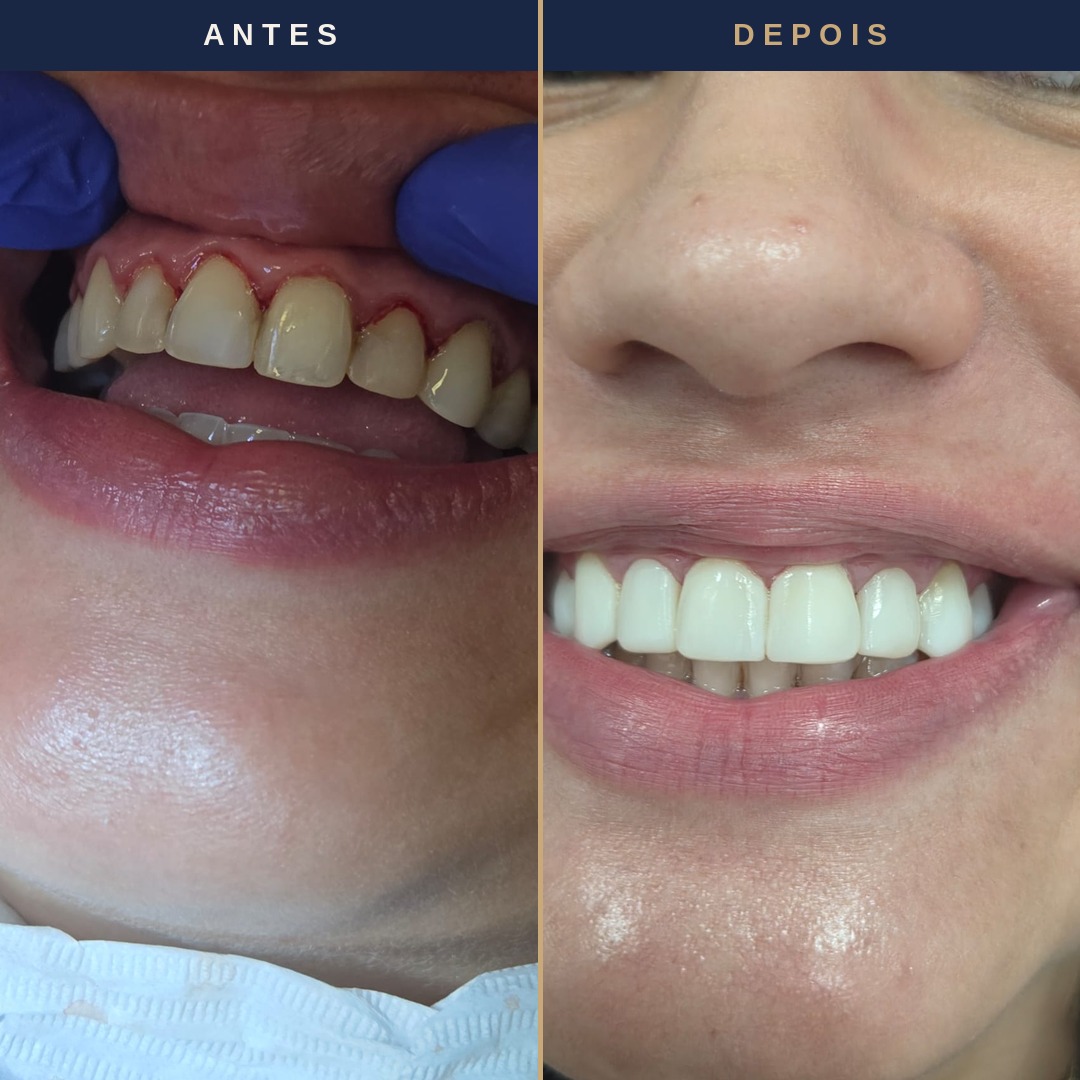 Antes e depois de faceta em resina &mdash; paciente Felicity