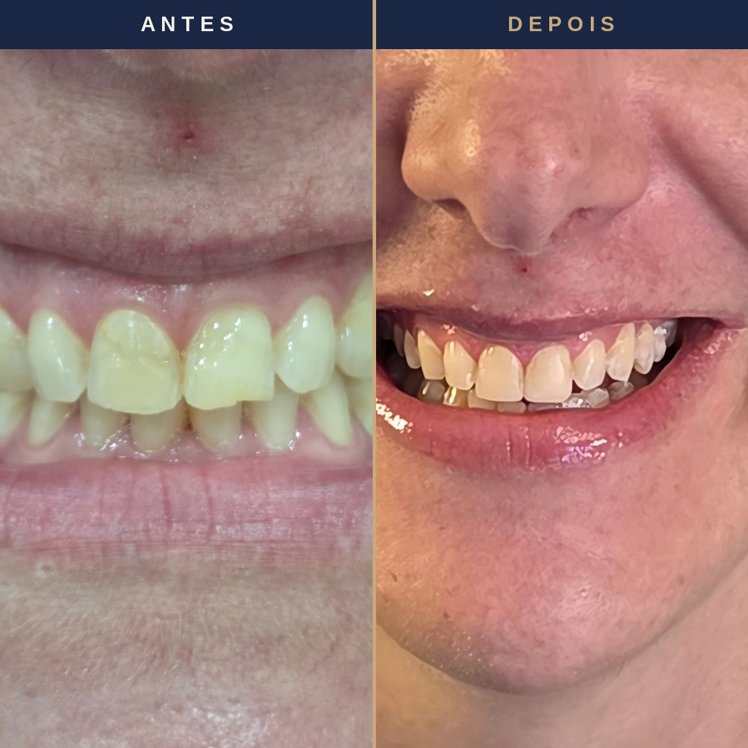 Antes e depois de lente de contato dental &mdash; paciente Felicity