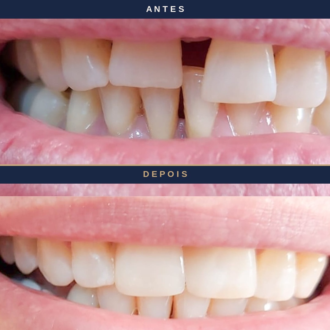 Antes e depois &mdash; faceta em resina, paciente Felicity