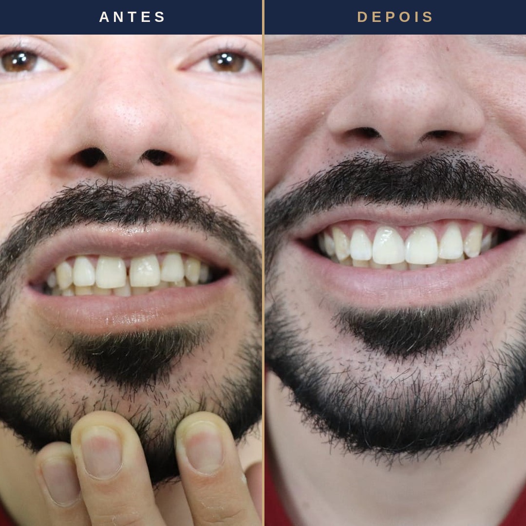 Antes e depois &mdash; faceta em resina, paciente Felicity