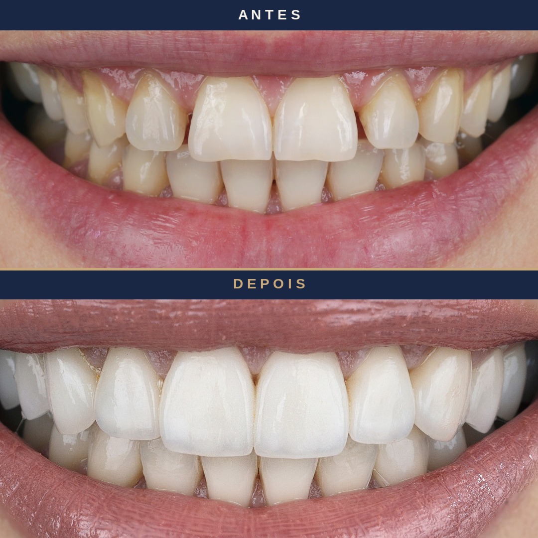 Antes e depois &mdash; faceta em resina, paciente Felicity
